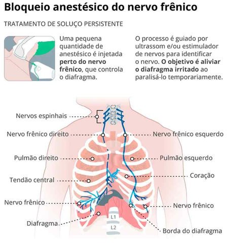Gráfico mostra o bloqueio anestésico do nervo frênico — Foto: Arte GLOBO